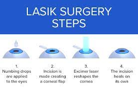 LASIK Surgery: Definition, Procedure, Results